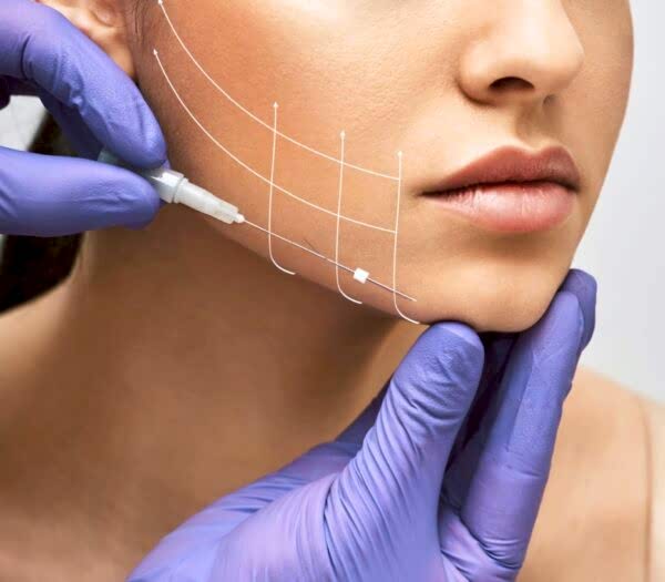 Лифтинг нитями Aptos (Аптос).