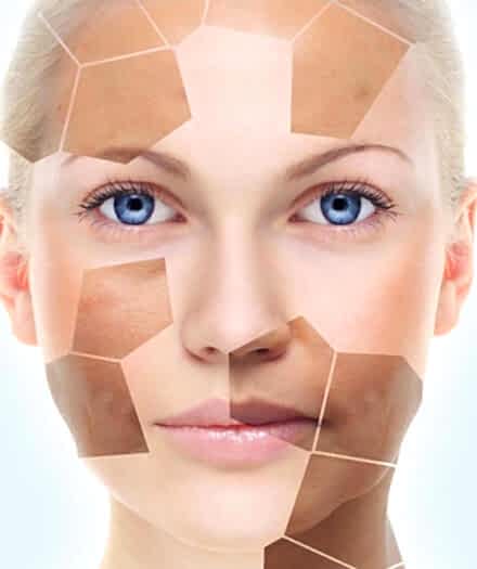 Фотоомоложение по суперцене!