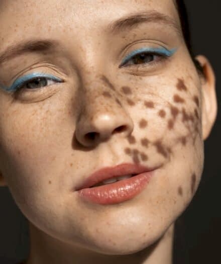 Удаление пигментных пятен